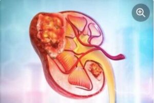 Tumor Renal