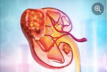 Tumor Renal